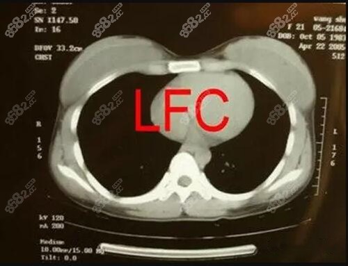 注入奥美定的胸部CT图