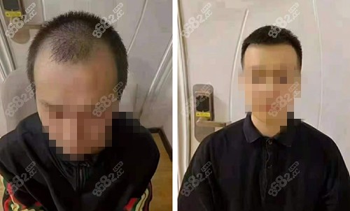东莞台心植发前后对比照