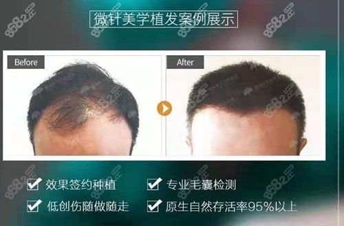 江西赣州叶子植发后对比照