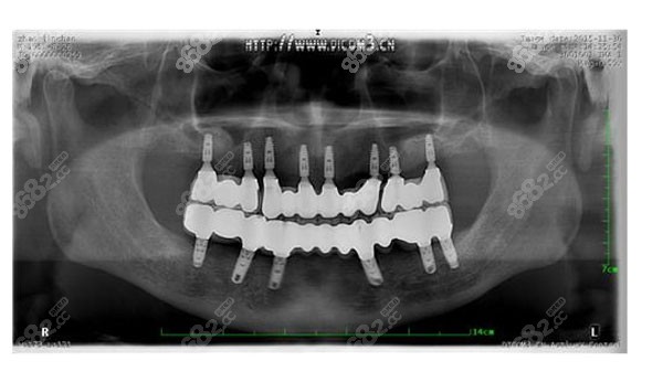 春芽口腔半全口种植牙