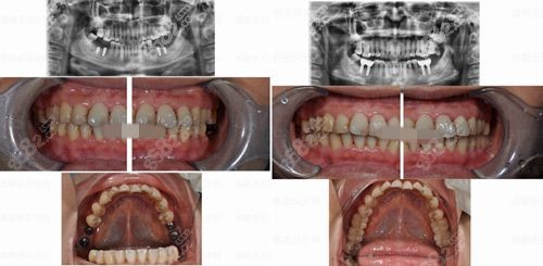 成都圣贝口腔种植牙对比照