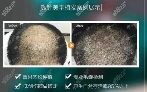 江西赣州叶子植发头顶加密种植恢复后照片