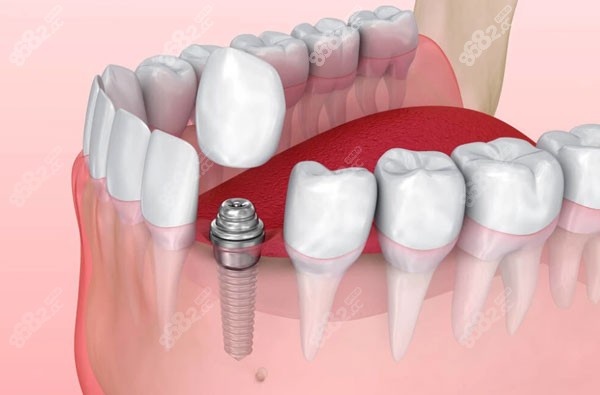 常德口腔医院种牙价格