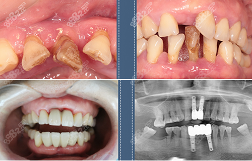 成都锦江极光口腔种植牙对比照