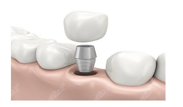 春芽口腔种植牙技术好