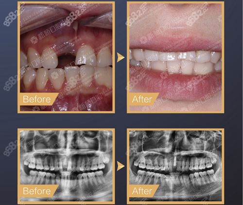 成都新桥口腔种植牙对比照