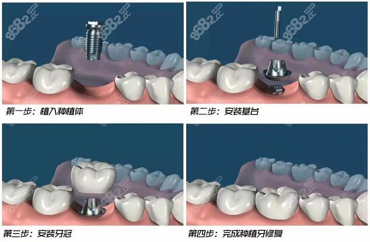来看看种植牙手术的步骤有哪些