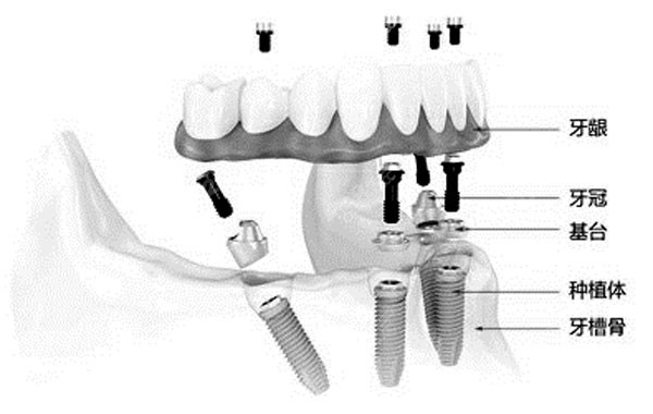 allon4半全口种植技术