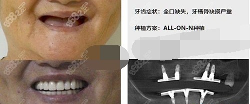 广州柏德口腔医院种植牙