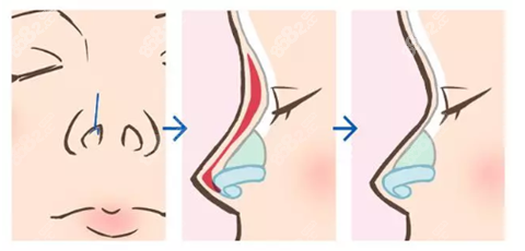 周蔚医生做鼻子的实例
