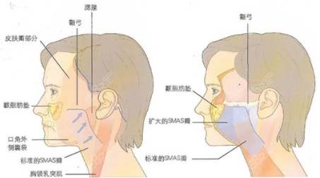 徐红霞密速提面部提升怎么样呢？