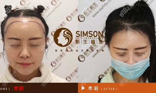 福州<!--<i data=20240705-sp></i>-->发际线种植术前术后对比图