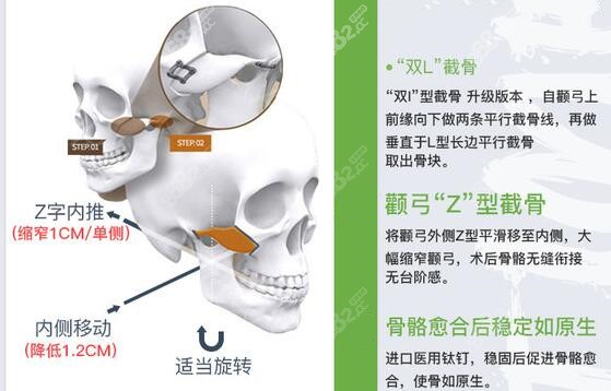 杭州时光“双I”型截骨+“双L”截骨个性化颧骨内推