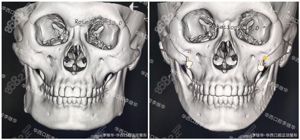 李继华医生下颌角截骨实例