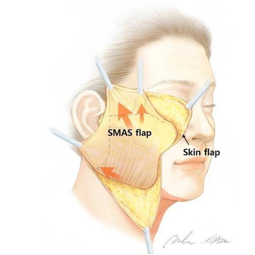 <!--<i data=20240705-sp></i>-->医生做拉皮手术的原理