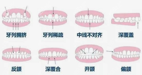 牙齿矫正的适应症