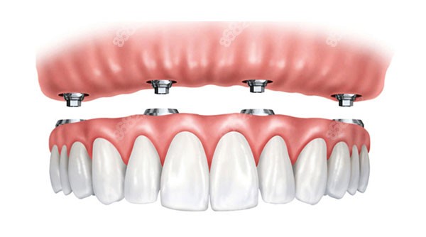 杭州做全口种植牙的价格