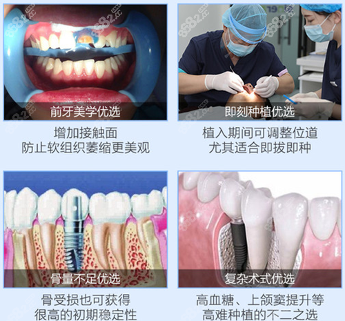 <!--<i data=20240705-sp></i>-->口腔种植牙优势