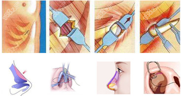 肋骨鼻综合手术示意图