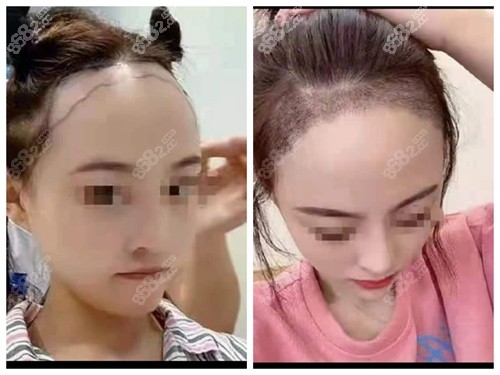 <!--<i data=20240705-sp></i>-->植发前后对比照
