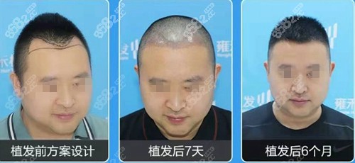 南通<!--<i data=20240705-sp></i>-->植发6个月后照片