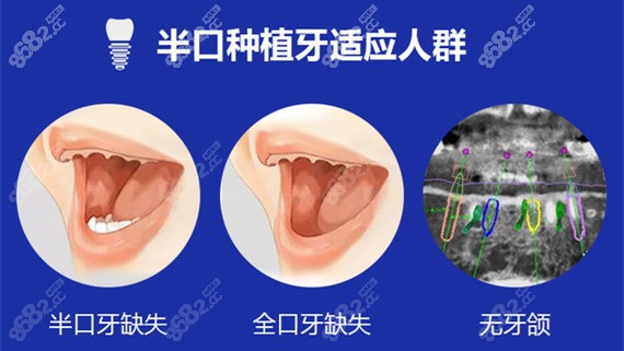 立得用半口种植牙适应人群