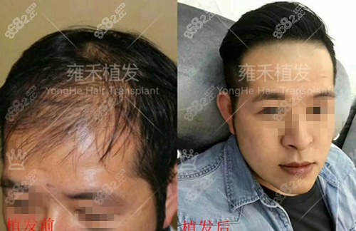 贵阳<!--<i data=20240705-sp></i>-->男士头顶加密种植术前术后对比图