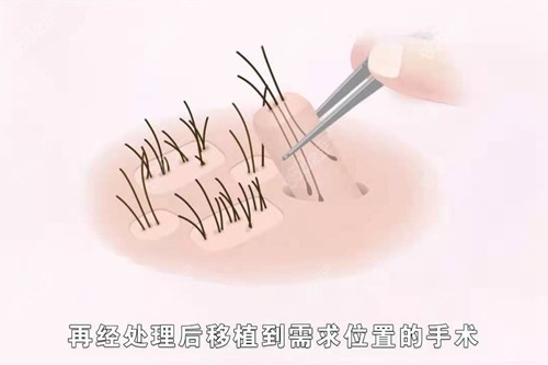 植发疼吗