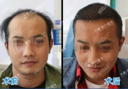 南通大麦微针植发前后变化大