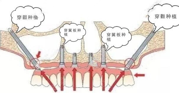 穿颧骨种植牙示意图图片