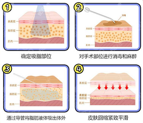 郭杰自体脂肪填充技术