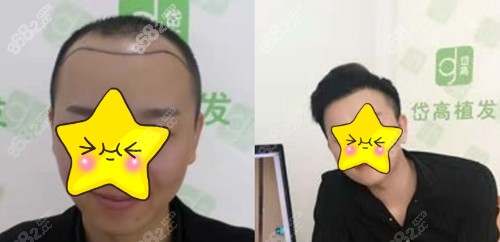 长沙岱高植发对比照