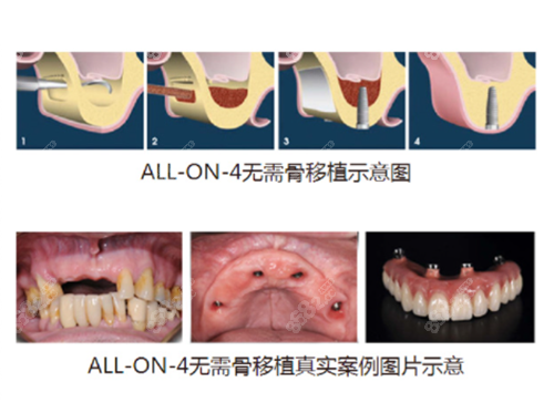 allon4全口种植牙无需移骨操作示意图