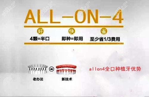 allon4全口种植牙技术优势