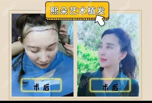 山东<!--<i data=20240705-sp></i>-->艺术发际线种植对比照分享