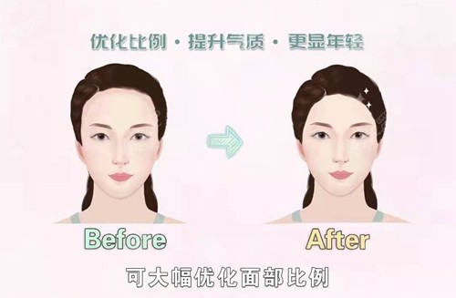 植发可以大幅度优化面部比例
