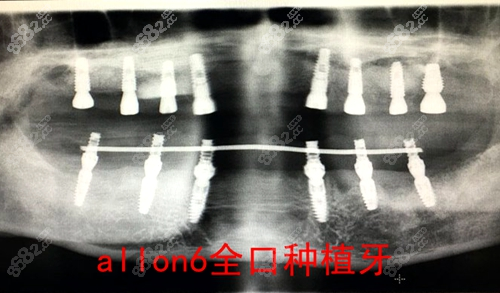 allon6全口种植牙CT展示图