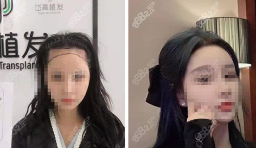 长沙岱高植发际线前后对比照