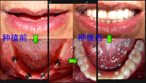 全口种植牙术前术后对比图