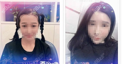 <!--<i data=20240705-sp></i>-->微针植发后变好看