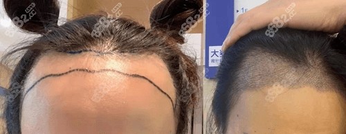 微针植发对比照
