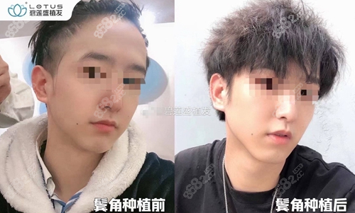 贵阳碧莲盛男士鬓角种植术前术后对比图