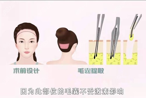 医生是怎么植发的呢？