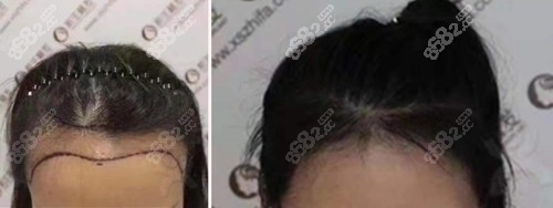 长沙<!--<i data=20240705-sp></i>-->植发后发际线明显前移