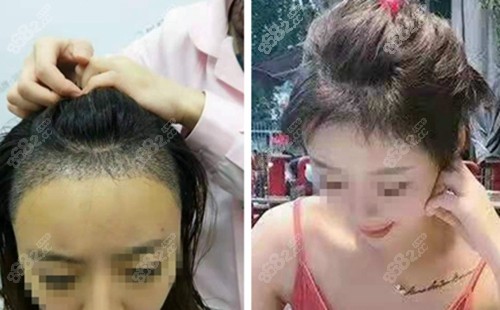 重庆瑞丽诗美学植发术后变化大