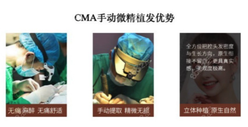 CMA手动精微植发