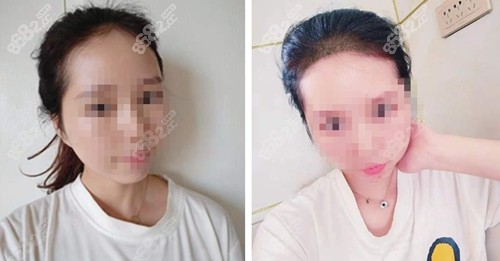 重庆<!--<i data=20240705-sp></i>-->植发前后对比