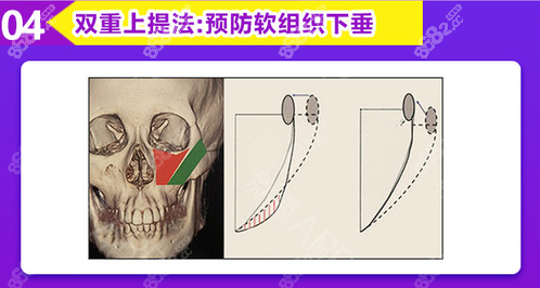 双重上提法预防脸下垂