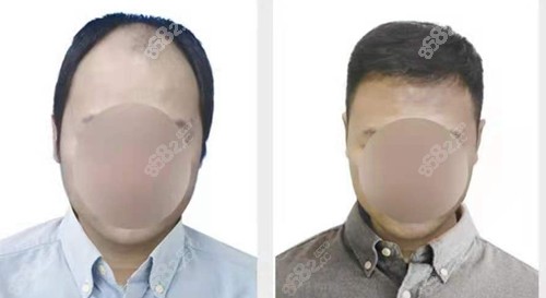 <!--<i data=20240705-sp></i>-->头顶加密种植前后对比明显