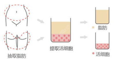 南京施尔美做面部脂肪填充取脂示意图